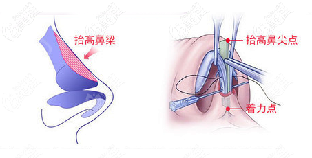 鄒進進隆鼻優(yōu)勢