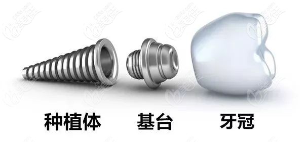 泰安康盛親水種植體 泰安康盛親水種植體