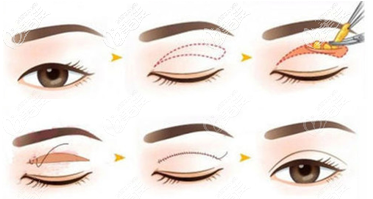 切開雙眼皮手術(shù)過程示意圖
