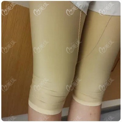 大腿環(huán)吸術(shù)后1個(gè)月穿戴緊身衣