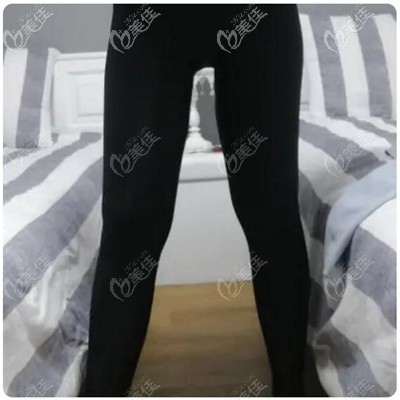 大腿環(huán)吸術(shù)后3個(gè)月效果