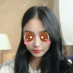 隆鼻能不能打法思麗玻尿酸？我鼻子就注射了1ml，效果還挺明顯的