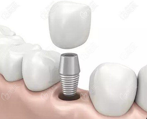 黃志斌醫(yī)生擅長的種植牙技術(shù) 黃志斌醫(yī)生擅長的種植牙技術(shù)