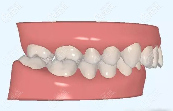 關(guān)于牙齒深覆頜的危害