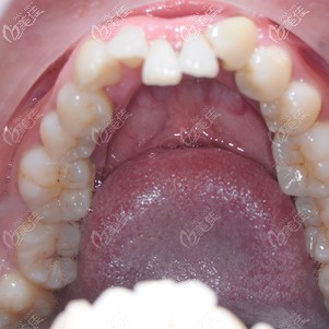 到東莞牙易美做牙齒矯正前 到東莞牙易美做牙齒矯正前