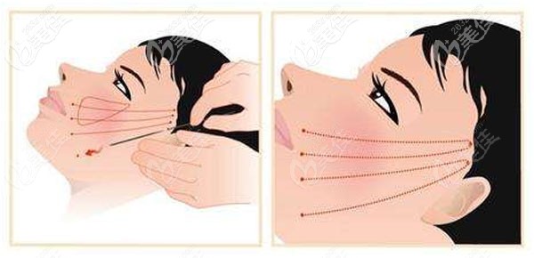 埋線提升手術(shù)