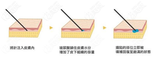 馬語嚀醫(yī)生注射技術(shù)優(yōu)勢(shì)
