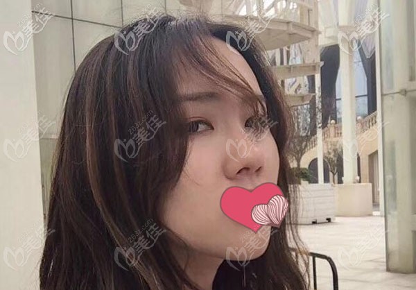 昆明吳氏嘉美韓國(guó)美迪菲硅膠隆鼻效果圖連載:我真后悔當(dāng)初鼻子打了玻尿酸