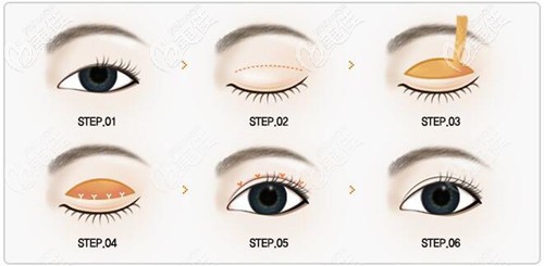 陳仁君雙眼皮手術(shù)風(fēng)格