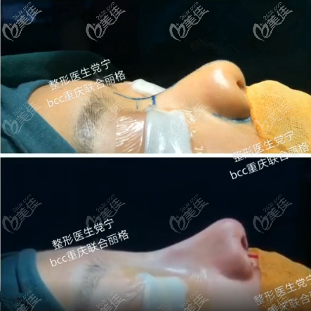 重慶聯(lián)合麗格隆鼻醫(yī)生黨寧案例 重慶聯(lián)合麗格隆鼻醫(yī)生黨寧案例