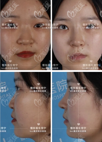 重慶聯(lián)合麗格醫(yī)院寧式隆鼻案例 重慶聯(lián)合麗格醫(yī)院寧式隆鼻案例