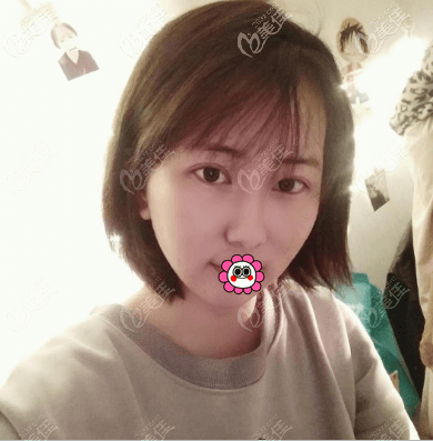 在北京蒂凡妮醫(yī)療美容做面部吸脂有7天了