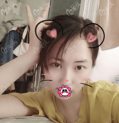 做面部抽脂半個多月樣子