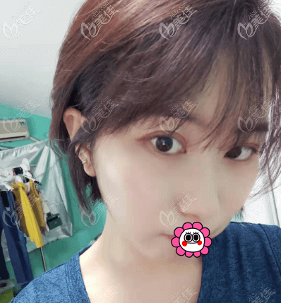 我在北京蒂凡妮做面部吸脂半年后,是沒有出現(xiàn)臉反復(fù)浮腫的情況