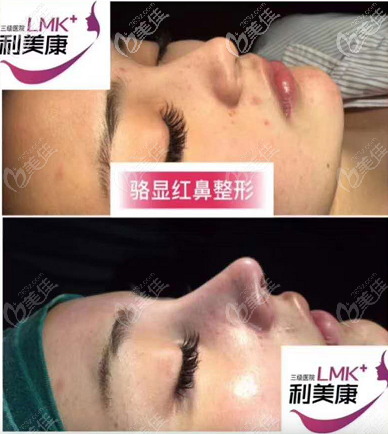 貴州利美康鼻綜合案例