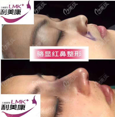 駱顯紅醫(yī)生駝峰鼻矯正案例