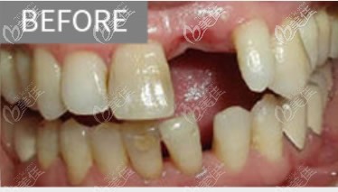 深圳博愛曙光口腔種植牙前 深圳博愛曙光口腔種植牙前