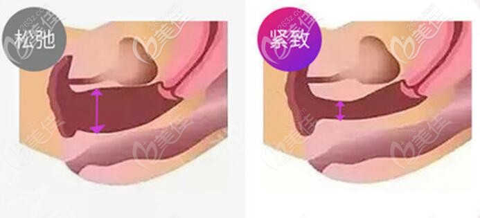 歐洲之星fonota4d縮陰效果前后對比圖