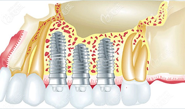 種植體國產(chǎn)和進口的區(qū)別大嗎