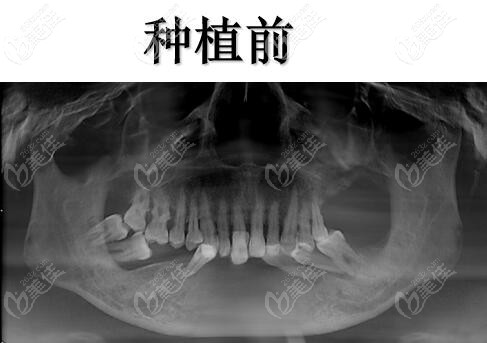 老爹種植前口內(nèi)情況 老爹種植前口內(nèi)情況