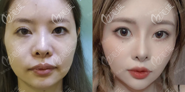 重慶祛眼袋哪里好 重慶祛眼袋哪里好