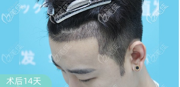 種植發(fā)際線毀了我一生?這樣的男士種植發(fā)際線效果圖片我寧愿讓“毀”我一生!