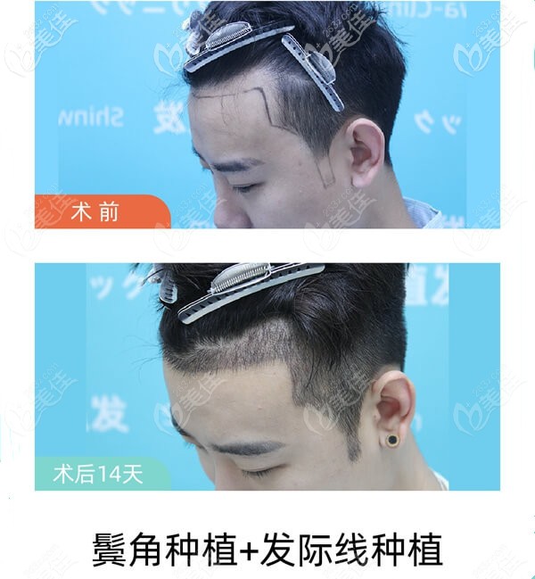 男士種植發(fā)際線效果圖片