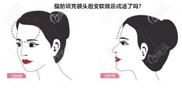 脂肪填充額頭后變軟就是成活了嗎