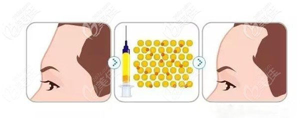 采用自體脂肪填充術(shù)后效果