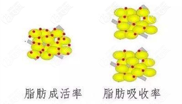脂肪填充的成活率和吸收率不成正比