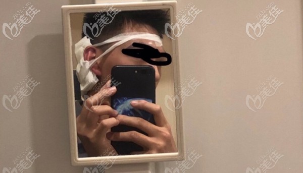 眉毛種植術(shù)后即刻效果