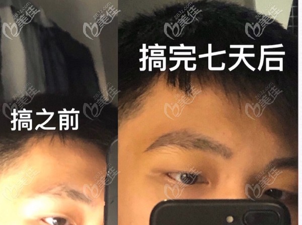 眉毛種植前后對(duì)比圖