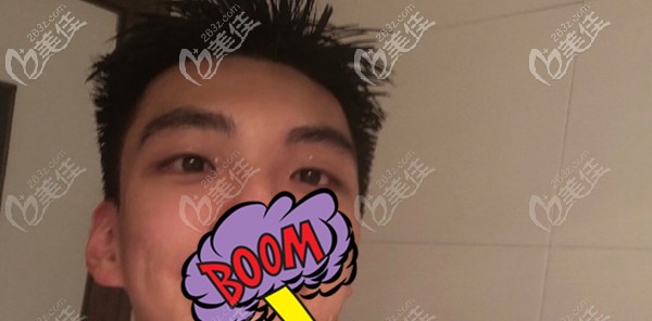男士紋眉好還是植眉好?瀏覽下我做男士種眉后的效果圖就曉得了!