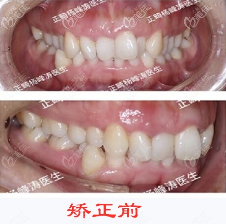深覆合牙齒矯正前的照片 深覆合牙齒矯正前的照片