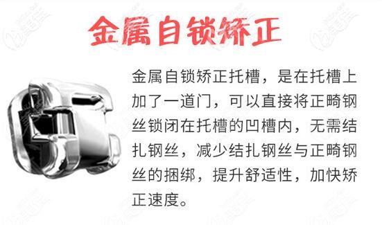 唐山牙博士口腔金屬自鎖托槽 唐山牙博士口腔金屬自鎖托槽