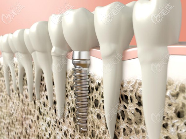 韓國(guó)仕諾康和奧齒泰哪個(gè)好 韓國(guó)仕諾康和奧齒泰哪個(gè)好