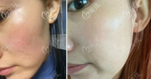 去西寧時(shí)光做激光祛紅血絲前后效果對(duì)比圖 去西寧時(shí)光做激光祛紅血絲前后效果對(duì)比圖