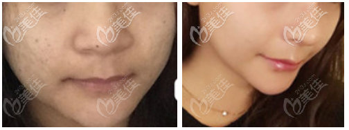 我做的c8激光祛斑效果 我做的c8激光祛斑效果