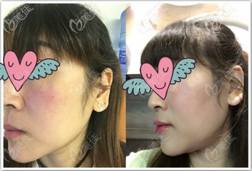 時(shí)光做激光祛紅血絲后的效果對(duì)比圖 時(shí)光做激光祛紅血絲后的效果對(duì)比圖