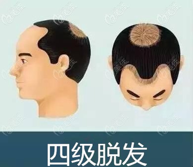 4級地中海脫發(fā)面積 4級地中海脫發(fā)面積