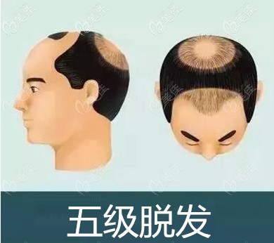 地中海5級脫發(fā)面積 地中海5級脫發(fā)面積
