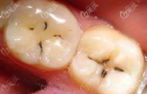 齲壞的牙齒圖片