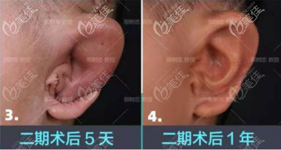 全包耳再造二期手術(shù)腫脹的樣子 全包耳再造二期手術(shù)腫脹的樣子