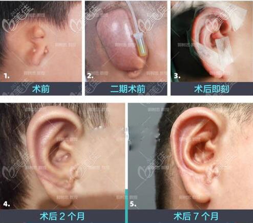 右耳畸形做全包耳再造手術(shù)效果前后對比 右耳畸形做全包耳再造手術(shù)效果前后對比