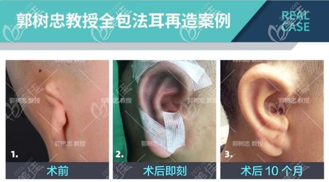 郭樹忠全包法耳再造案例效果對比圖 郭樹忠全包法耳再造案例效果對比圖