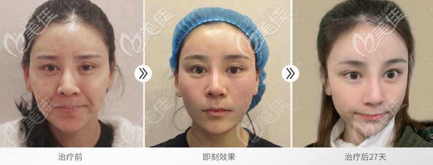 鄭荃院長(zhǎng)RNT脂肪修復(fù)案例