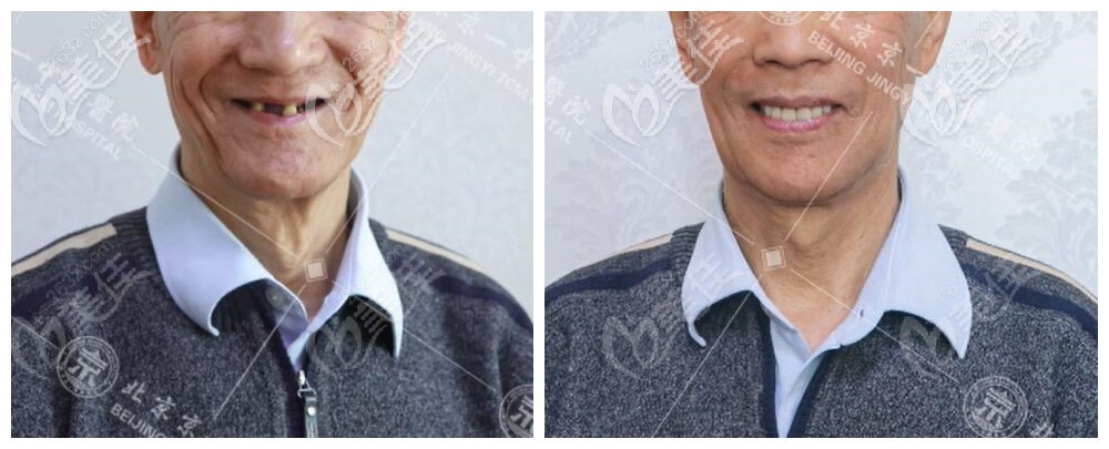 滿口種植牙前后<span style=