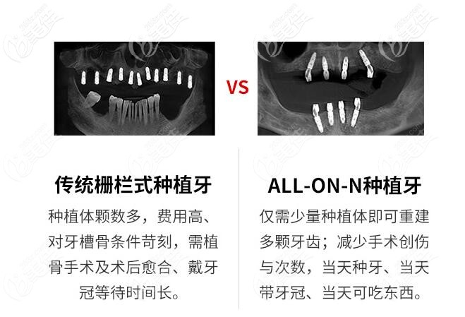 allon4種植技術(shù)和傳統(tǒng)種植技術(shù)區(qū)別