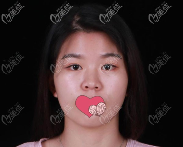 在昆明吳氏嘉美隆鼻手術前 在昆明吳氏嘉美隆鼻手術前