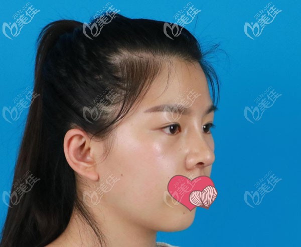 半肋骨鼻綜合15天弧度很自然 半肋骨鼻綜合15天弧度很自然